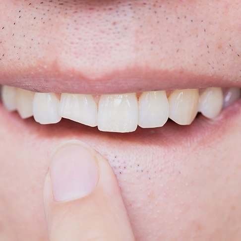 You may be a good candidate for cosmetic bonding if your mouth is in good health