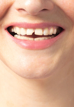 Closeup of a broken tooth