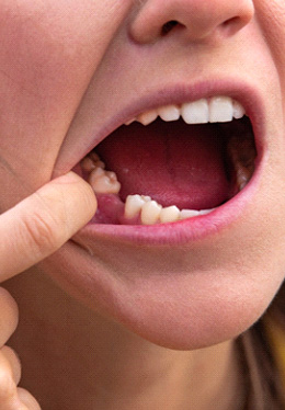 Woman with a missing tooth