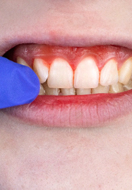 Closeup of bleeding gums