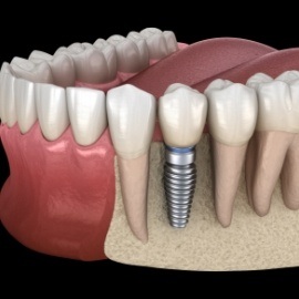 Animated smile with dental implant supported dental crown placed