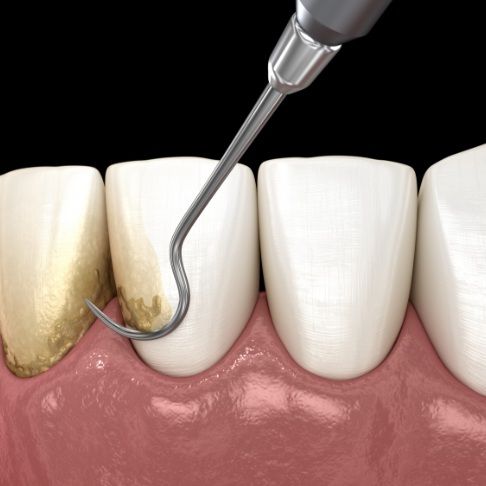 Animated smile during gum disease treatment