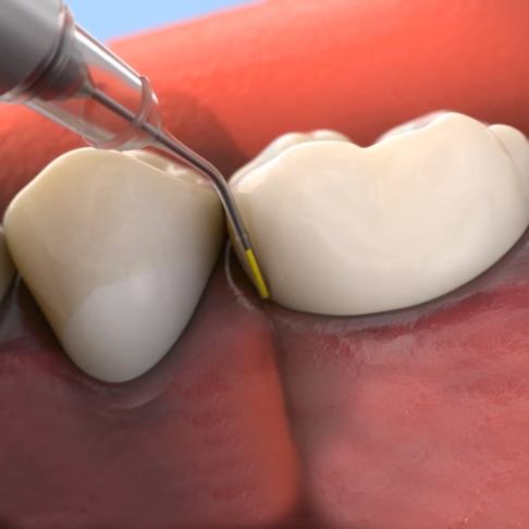 Animated smile during topical antibiotic treatment