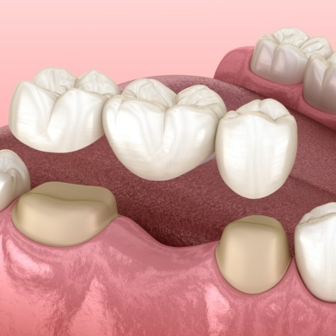 Animated smile during dental bridge placement