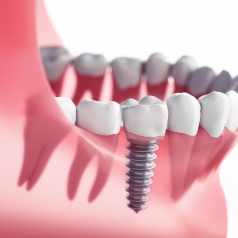 Animated smile with dental implant supported replacement tooth