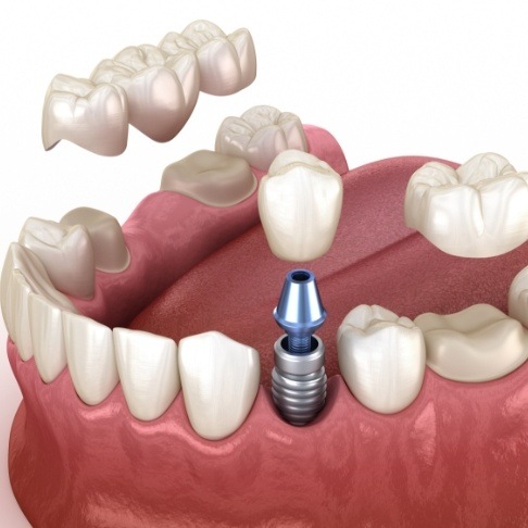 Animated smile during full mouth reconstruction