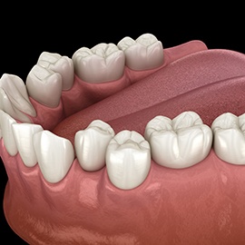 Digital image of crowded teeth