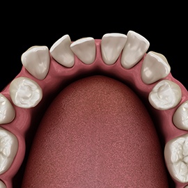 Digital image of gapped teeth