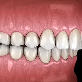 Digital image of an overbite