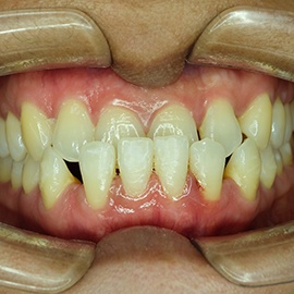 Image of an underbite