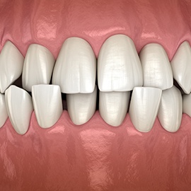 Digital image of a crossbite