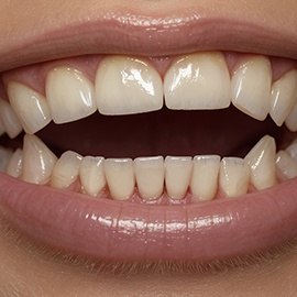 Up-close image of an open bite