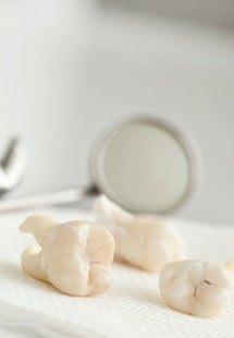 extracted wisdom teeth atop gauze pads near Highland Park