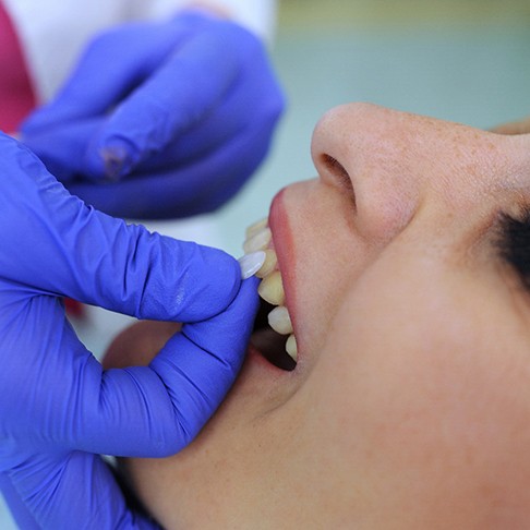 Close-up of two veneers in Deerfield, IL