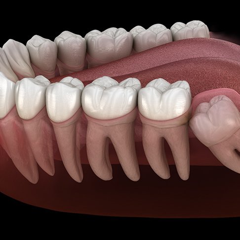 Illustration of wisdom tooth breaking through the gumline