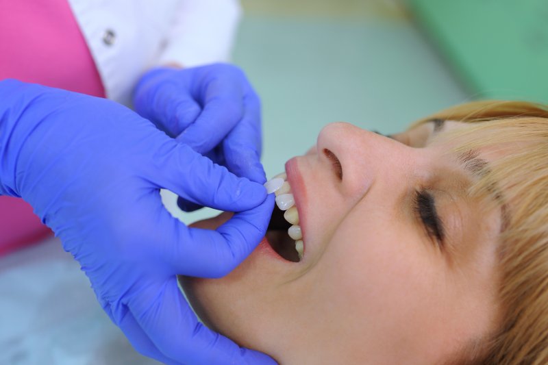 A dentist placing dental veneers on a patient’s smile