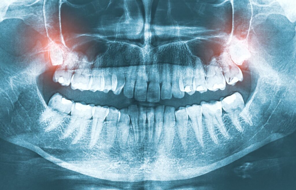 X-ray with wisdom teeth in upper arch highlighted