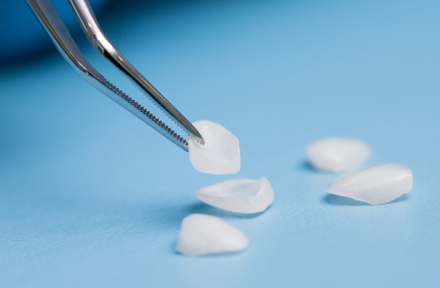 Veneers being picked up by forceps